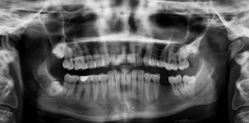 Czy wykonanie zdjęcia RTG zęba jest bezpieczne? - fot. partnera