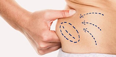 Liposukcja a odchudzanie – czym różni się modelowanie ciała od redukcji wagi?