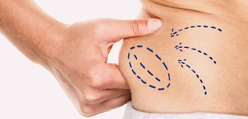 Liposukcja a odchudzanie – czym różni się modelowanie ciała od redukcji wagi?